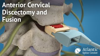 Anterior Cervical Discectomy and Fusion [upl. by Stone]