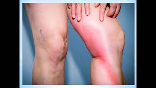 What is Phlebitis and How is it Treated [upl. by Naivaf]