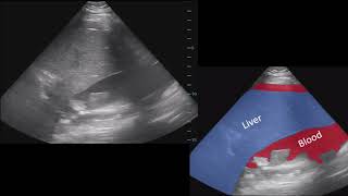 Splenic Rupture FAST Ultrasound 52020 [upl. by Iramat560]