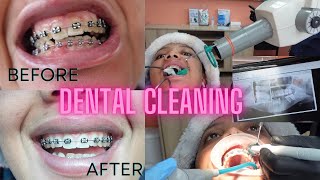 CLEANING my teeth and BRACES 😬  Dental care  South African YouTuber [upl. by Liagibba]