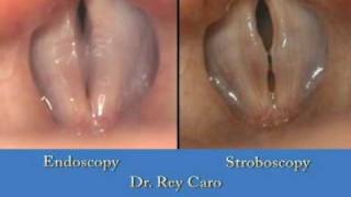 Endoscopy vs Stroboscopy Dr Rey Caro [upl. by Nnyltiac964]