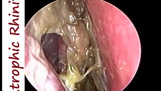 Atrophic Rhinitis Ozaena  Operated Youngs on Left amp Modified Youngs operation on Right [upl. by Lesiram914]