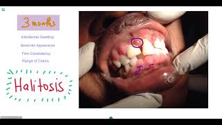 DrugInduced Gingival Enlargement [upl. by Laikeze]