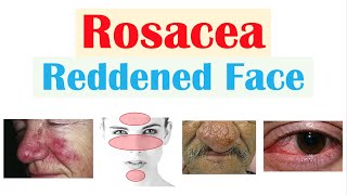 Rosacea Red Lesions on Face  Causes Triggers Types Signs amp Symptoms Diagnosis Treatment [upl. by Ahsienad808]