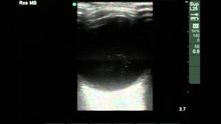 Ocular Ultrasound Vitreous Hemorrhage [upl. by Catima]