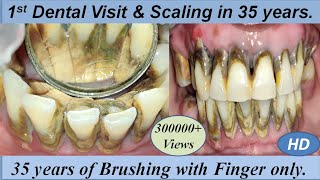 Massive Firm amp Hard Black Calculus Removal by Ultrasonic Scaling I 1st Dental Cleaning in 35 years [upl. by Neimad]