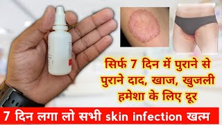 सिर्फ 7 दिन में पुराने से पुराने दाद खाज खुजली हमेशा के लिए दूर  Dad khaj khujli best medicine [upl. by Gemma65]