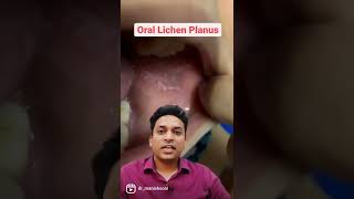 Oral lichen planus is achronic inflammatory condition For appointment 9310115620  01244367729 [upl. by Yaker]