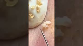 Pickel Ausdrücken Blackheads Akne amp Mitesser entfernen 🔴 43 [upl. by Karmen]