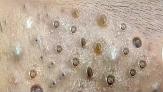 Big Cystic Acne Blackheads Extraction Blackheads amp Milia Whiteheads Removal Pimple Popping  1874 [upl. by Enelyak]