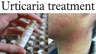 Urticaria Homeopathy Treatment  Pitti Uchalne Par Kiya Karte Hain  Urticaria Treatment In Hindi [upl. by Spillihp]