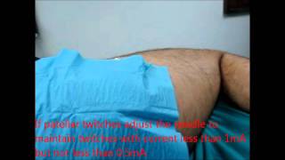 posterior lumbar plexus block nerve stimulationwmv [upl. by Kolivas]