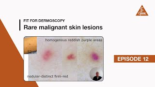 Fit for Dermoscopy Episode 12  Rare malignant skin lesions [upl. by Emmi529]