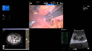 BK Medical Robotic Assisted Partial Nephrectomy RAPN by Dr James R Porter [upl. by Erodeht]