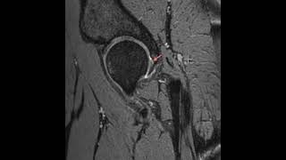 Tear of the posterior hip labrum [upl. by Yesnyl]