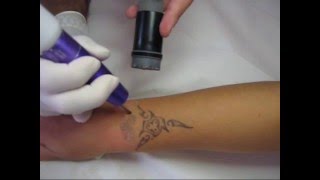 Laser Tattoo removal Dottor Giuseppe Picarella Messina [upl. by Yliram]