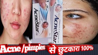 acne treatmentacnestar gelsoap pimples ka ilaajpimples ki dawaclin3 gelpersol ac 25 [upl. by Orran]