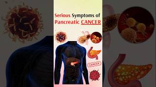 Serious symptoms of pancreatic cancer [upl. by Aivart]