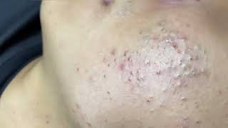 blackhead removal new this week 2024 [upl. by Ancilin101]