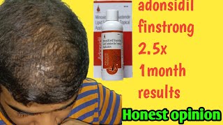 Adonsidil finstrong 25x  1months honest result amp my opinion ADONHAIRCARE [upl. by Gerhard143]