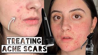 HOW TO GET RID OF ACNE SCARS AT HOME WITH MICRONEEDLING  Banisher Tutorial [upl. by Htinnek]