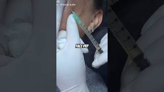 Face PRP l Face Prp treatment l Face Prp procedure faceprp prp microneedling viral shortsvideo [upl. by Germayne]