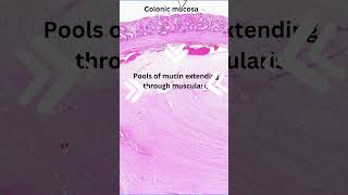 Histology of colitis cystica profunda [upl. by Esdnil235]