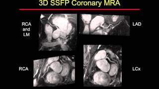 MR Angiography Techniques [upl. by Lady]