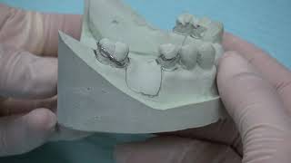 CONSTRUCTION OF COMPONENTs for Removable partial denture  Acrylic [upl. by Ycal]