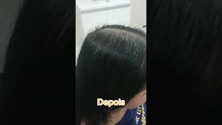 Alopecia Androgenética Antes e DepoisVejam Esse Antes e Depois Surpreendente LINK ABAIXO shorts [upl. by Aidan]