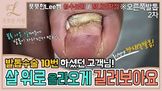 발톱수술 10번 하셨던 고객님 이번엔 반대쪽발톱 2차 살위로 올라오게 길러보아요 tinea unguium  Fresh Foot 풋풋한리쌤 성수점  평내호평점 [upl. by Sophy]