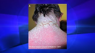 Could This Happen to You Crusted Scabies  The Doctors [upl. by Haslam]