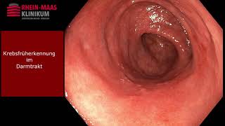 Koloskopie  Die Spiegelung des End und Dickdarms [upl. by Dexter]