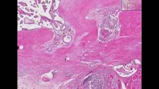 Histopathology ThyroidHashimoto thyroiditis papillary car [upl. by Oballa]