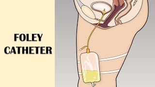 Foley Catheter  Structure amp Parts Indications Procedure Suprapubic Catheterization Risks [upl. by Akinahc]