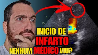 SINAIS DE INFARTO podem começar ANTES DOS SINTOMAS DE INFARTO Veja um MIOCÁRCDIO no ECOCARDIOGRAMA [upl. by Ilatan]