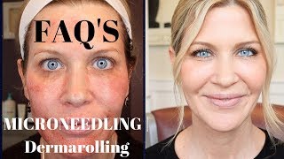 Microneedling  Dermarolling QampA  Before During and After Pics [upl. by Audly]