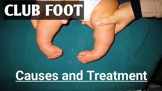 Clubfoot Deformity Clubfoot Physiotherapy How to treat ClubFoot [upl. by Aissilem]