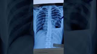 HOW TO DESCRIBE CHEST XRAY OF HYDROPNEUMOTHORAX PNEUMOTHORAX PLEURAL EFFUSIONchestxray ytshorts [upl. by Llenrac]