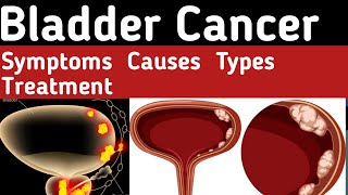 Bladder Cancer Types What causes bladder cancer Bladder Cancer Symptoms Bladder Cancer Treatment [upl. by Hanna736]