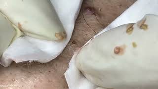 Big Cystic Acne Blackheads Extraction Blackheads amp Milia Whiteheads Removal Pimple Popping [upl. by Begga116]