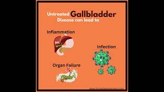 Untreated Gallstones can be harmful [upl. by Hobbie]