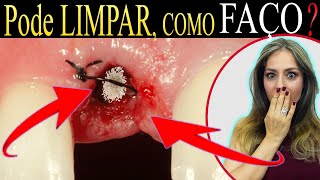 Como faço pra HIGIENIZAR o Lugar da CIRURGIA Extrai um dente como faço pra Limpar o local 68 [upl. by Ahtivak735]