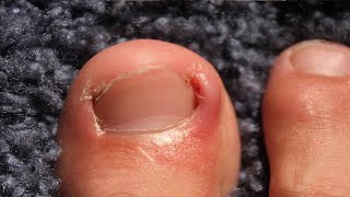 how to get rid of ingrown toenails with dental floss [upl. by Nahraf]