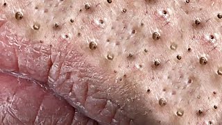 Big Cystic Acne Blackheads Extraction Blackheads amp Milia Whiteheads Removal Pimple Popping  5378 [upl. by Ennirok]