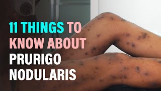 11 Things to Know About Prurigo Nodularis Nodular Prurigo [upl. by Mazman]