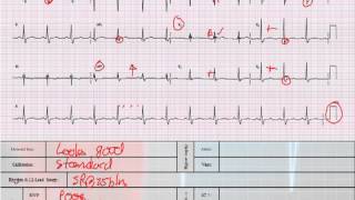 12 Lead Interpretation Part 41 Bundle Branch and Fascicular Blocks [upl. by Langston]