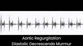 Aortic Regurgitation Diastolic Murmur [upl. by Ja761]