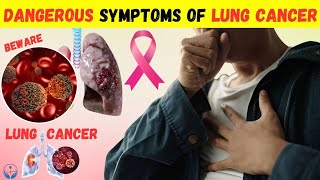 Dangerous Symptoms of lung cancer [upl. by Nnaassilem]