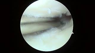 L knee debridement 11 14 24 ST [upl. by Rubliw]